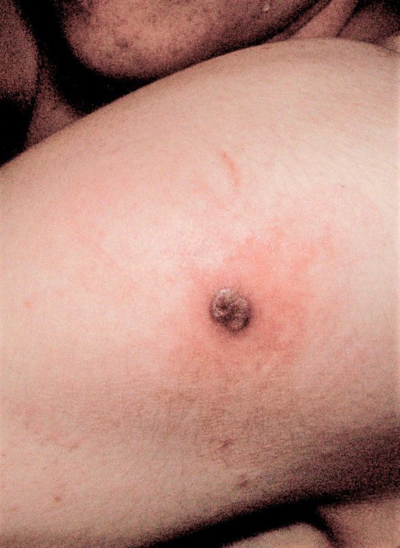 Impfstelle nach einigen Tagen, woraus später die früher typische Impfnarbe entstand. (Foto: wikipedia.org)